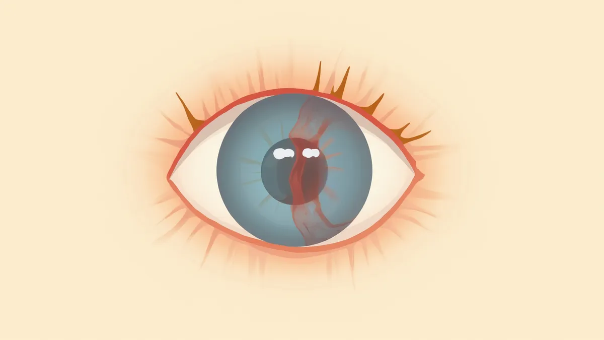 망막이 안쪽 벽에서 떨어진 상태를 보여주는 강아지 눈 단면 일러스트